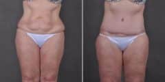 Tummy Tuck Before and After Photos in Omaha, NE, Case 7794