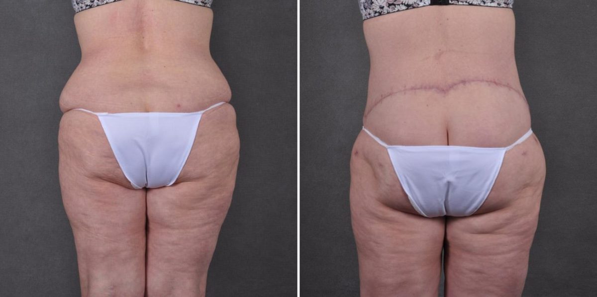 Tummy Tuck Before and After Photos in Omaha, NE, Case 7794