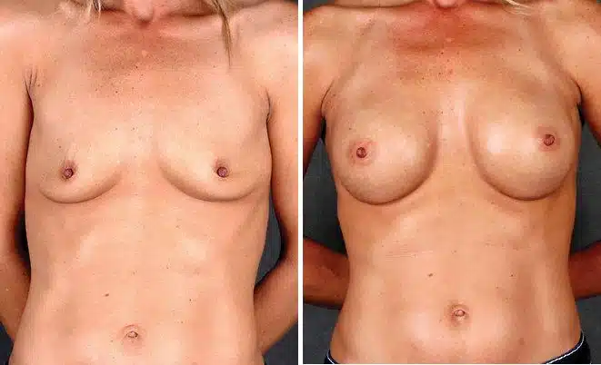 Breast Augmentation Before and After Photos in Omaha, NE, Case 5090