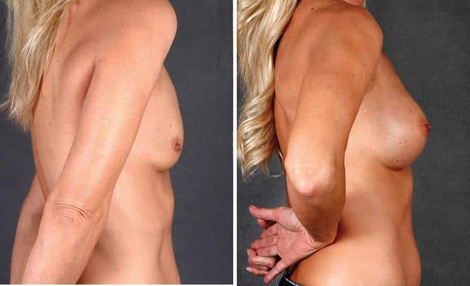 Breast Augmentation Before and After Photos in Omaha, NE, Case 5090