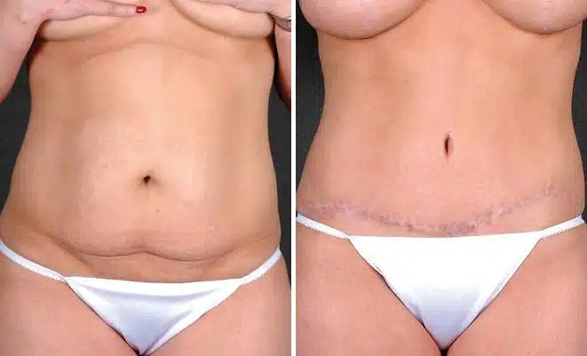 Breast Augmentation Before and After Photos in Omaha, NE, Case 5097