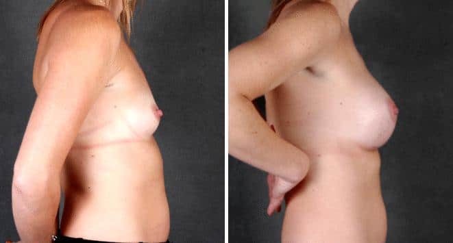 Breast Augmentation Before and After Photos in Omaha, NE, Case 5049