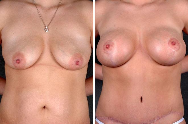 Breast Augmentation Before and After Photos in Omaha, NE, Case 5097