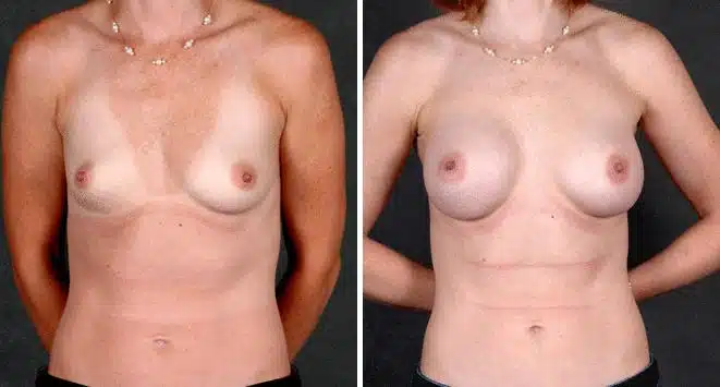 Breast Augmentation Before and After Photos in Omaha, NE, Case 5111