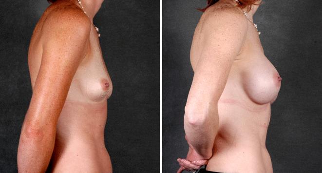 Breast Augmentation Before and After Photos in Omaha, NE, Case 5111