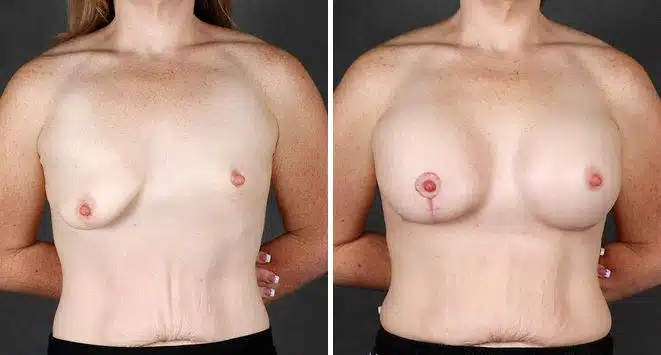 Breast Augmentation Before and After Photos in Omaha, NE, Case 5118