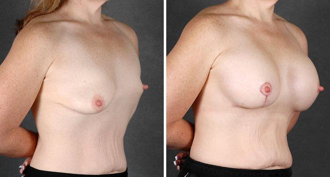 Breast Augmentation Before and After Photos in Omaha, NE, Case 5118