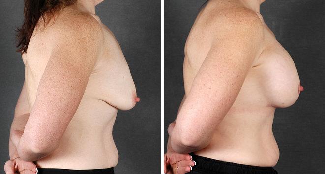 Breast Augmentation Before and After Photos in Omaha, NE, Case 5118