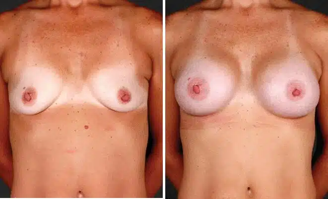 Breast Augmentation Before and After Photos in Omaha, NE, Case 5147