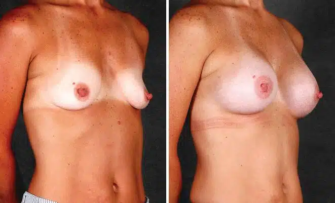 Breast Augmentation Before and After Photos in Omaha, NE, Case 5147