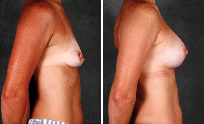 Breast Augmentation Before and After Photos in Omaha, NE, Case 5147