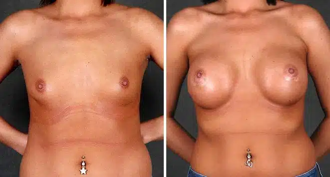 Breast Augmentation Before and After Photos in Omaha, NE, Case 5159