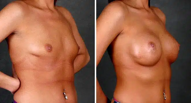 Breast Augmentation Before and After Photos in Omaha, NE, Case 5159