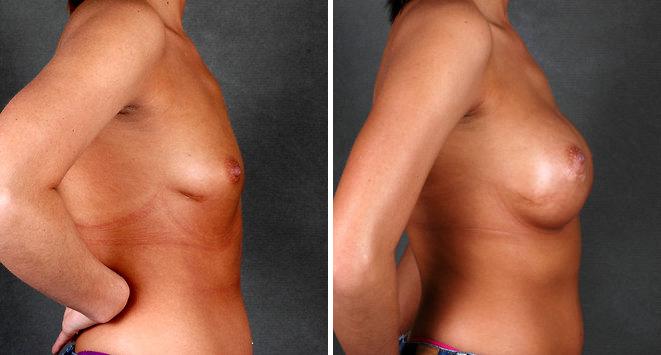 Breast Augmentation Before and After Photos in Omaha, NE, Case 5159