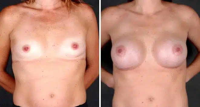 Breast Augmentation Before and After Photos in Omaha, NE, Case 5049