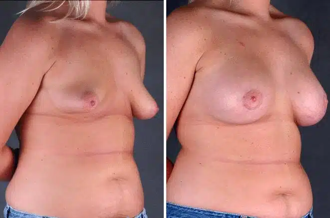 Breast Augmentation Before and After Photos in Omaha, NE, Case 5166