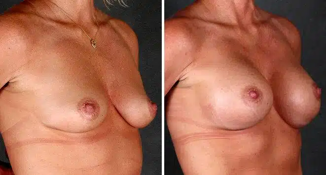 Breast Augmentation Before and After Photos in Omaha, NE, Case 5201