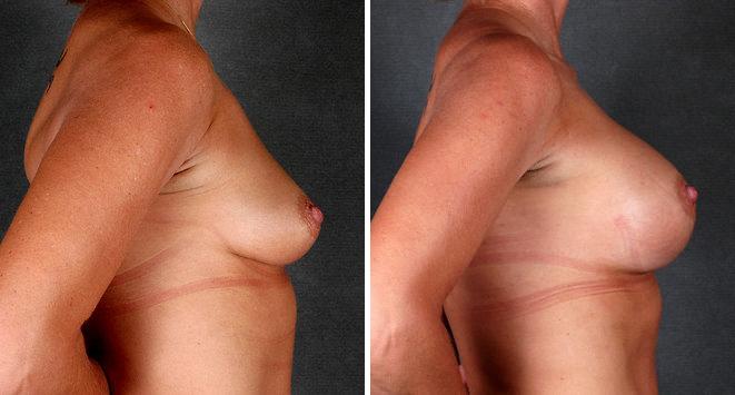 Breast Augmentation Before and After Photos in Omaha, NE, Case 5201