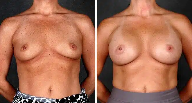 Breast Augmentation Before and After Photos in Omaha, NE, Case 5208