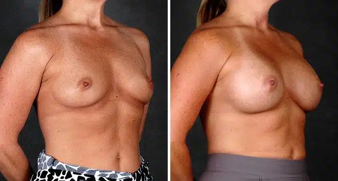 Breast Augmentation Before and After Photos in Omaha, NE, Case 5208