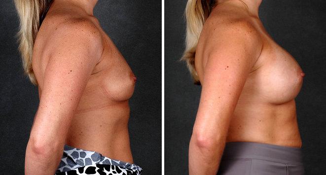 Breast Augmentation Before and After Photos in Omaha, NE, Case 5208