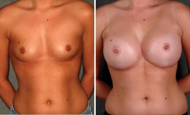 Breast Augmentation Before and After Photos in Omaha, NE, Case 5220