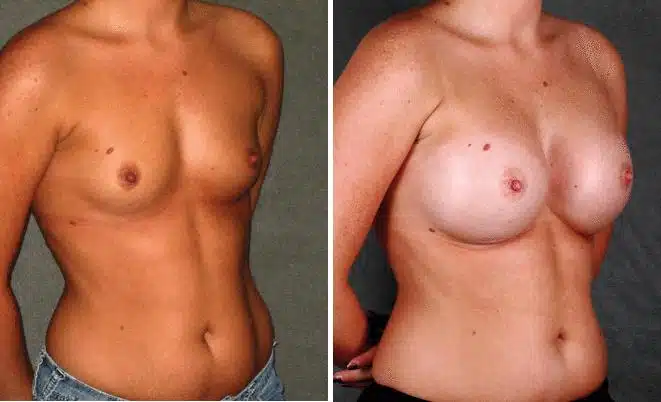 Breast Augmentation Before and After Photos in Omaha, NE, Case 5220