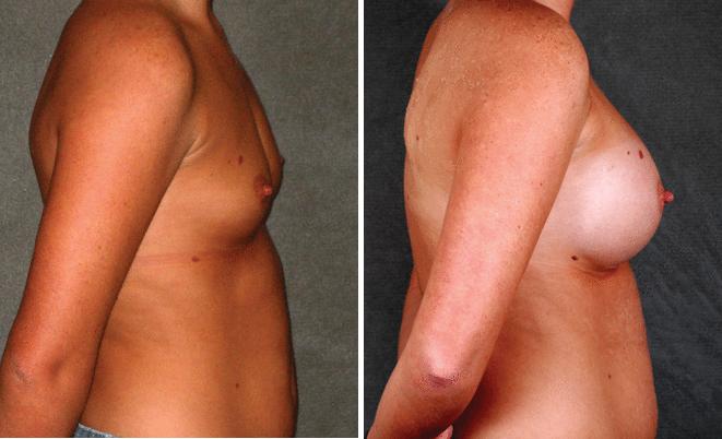 Breast Augmentation Before and After Photos in Omaha, NE, Case 5220