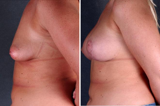 Breast Augmentation Before and After Photos in Omaha, NE, Case 5166