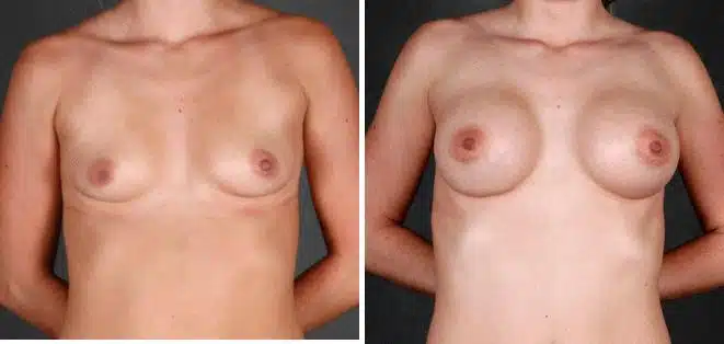 Breast Augmentation Before and After Photos in Omaha, NE, Case 5227