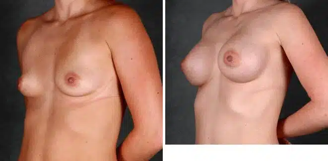 Breast Augmentation Before and After Photos in Omaha, NE, Case 5227