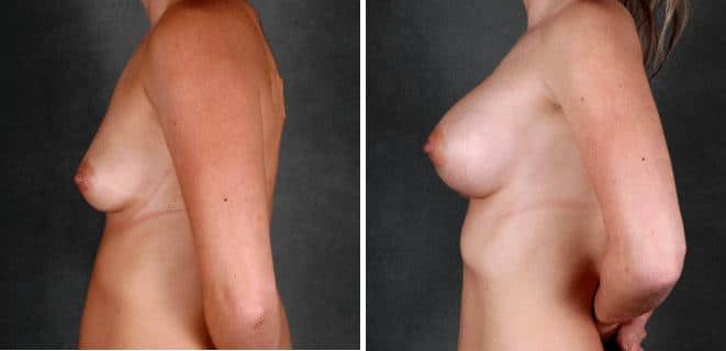 Breast Augmentation Before and After Photos in Omaha, NE, Case 5227