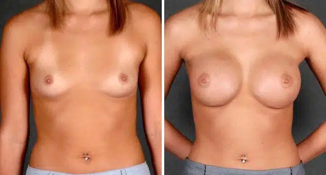 Breast Augmentation Before and After Photos in Omaha, NE, Case 5235