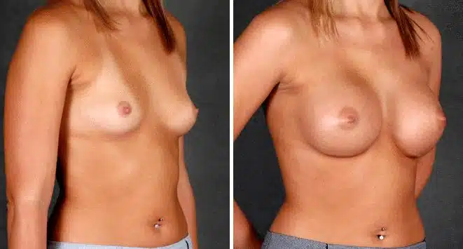 Breast Augmentation Before and After Photos in Omaha, NE, Case 5235