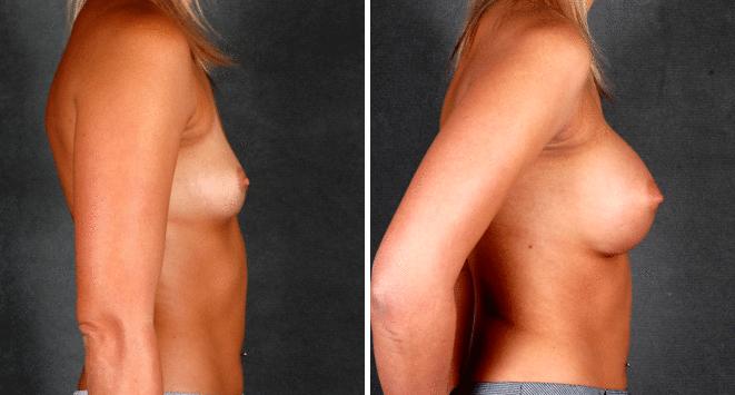 Breast Augmentation Before and After Photos in Omaha, NE, Case 5235