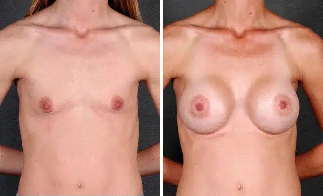 Breast Augmentation Before and After Photos in Omaha, NE, Case 5269