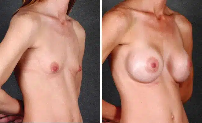 Breast Augmentation Before and After Photos in Omaha, NE, Case 5269