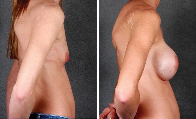 Breast Augmentation Before and After Photos in Omaha, NE, Case 5269