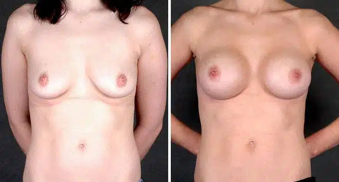 Breast Augmentation Before and After Photos in Omaha, NE, Case 5173