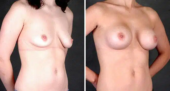 Breast Augmentation Before and After Photos in Omaha, NE, Case 5173