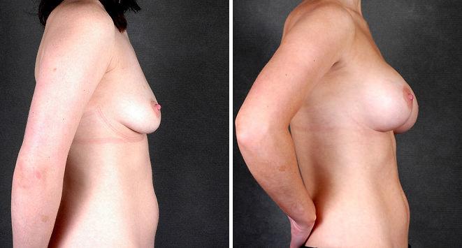 Breast Augmentation Before and After Photos in Omaha, NE, Case 5173