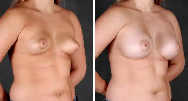 Breast Augmentation Before and After Photos in Omaha, NE, Case 5187