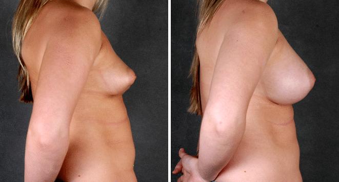 Breast Augmentation Before and After Photos in Omaha, NE, Case 5187