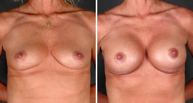 Breast Augmentation Before and After Photos in Omaha, NE, Case 5201