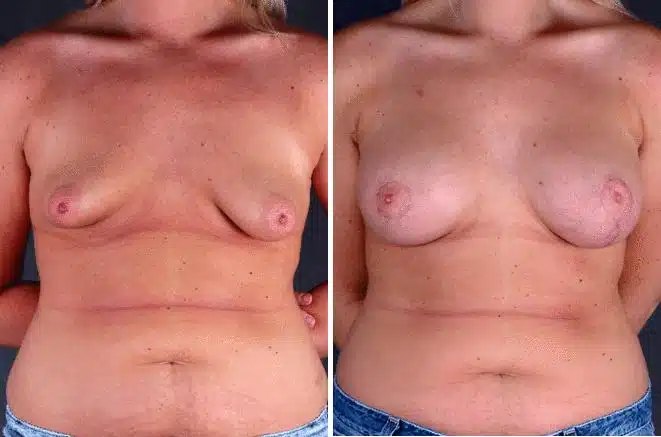 Breast Augmentation Before and After Photos in Omaha, NE, Case 5166