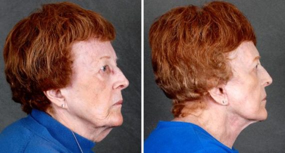 Blepharoplasty Before and After Photos in Omaha, NE, Case 5257