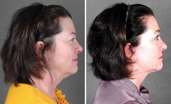 Blepharoplasty Before and After Photos in Omaha, NE, Case 5317