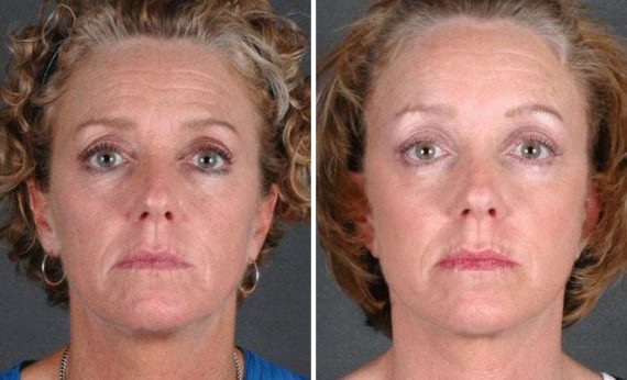 Blepharoplasty Before and After Photos in Omaha, NE, Case 5338