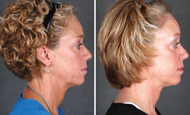 Blepharoplasty Before and After Photos in Omaha, NE, Case 5338