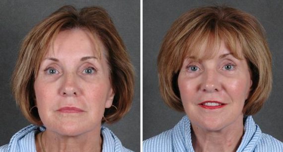 Blepharoplasty Before and After Photos in Omaha, NE, Case 5360